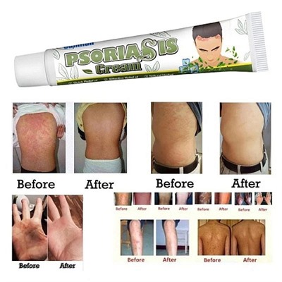 Sumifun Мазь от псориаза Psoriasis cream, 20 гр